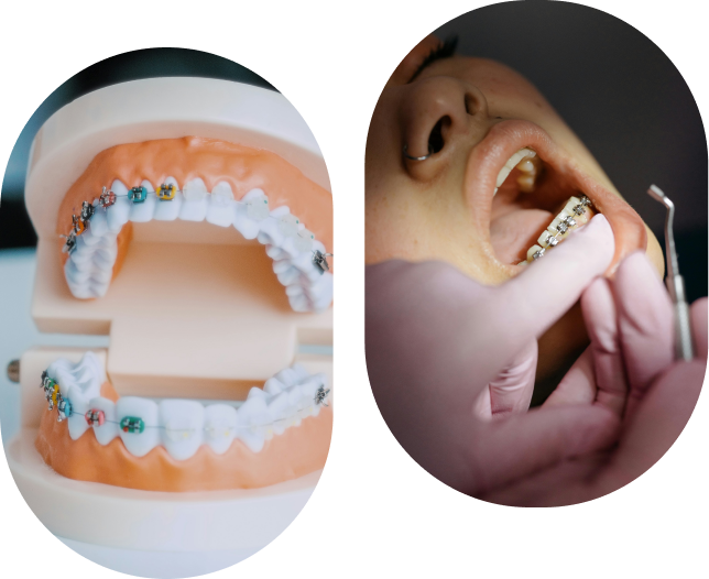 Image d'un patient portant un appareil orthodontique pour redresser les dents