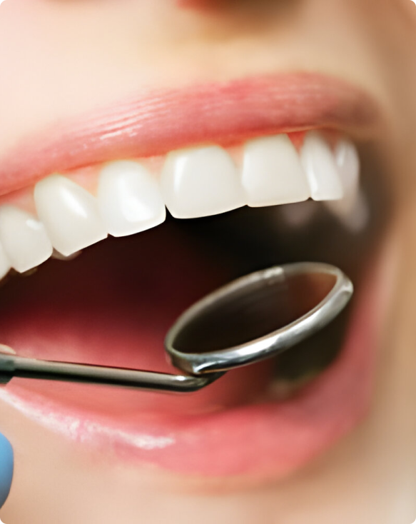 Photo après le blanchiment dentaire, montrant une nette amélioration de la couleur des dents