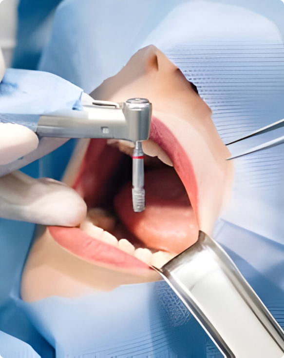 Photo d'une bouche après une extraction dentaire réussie