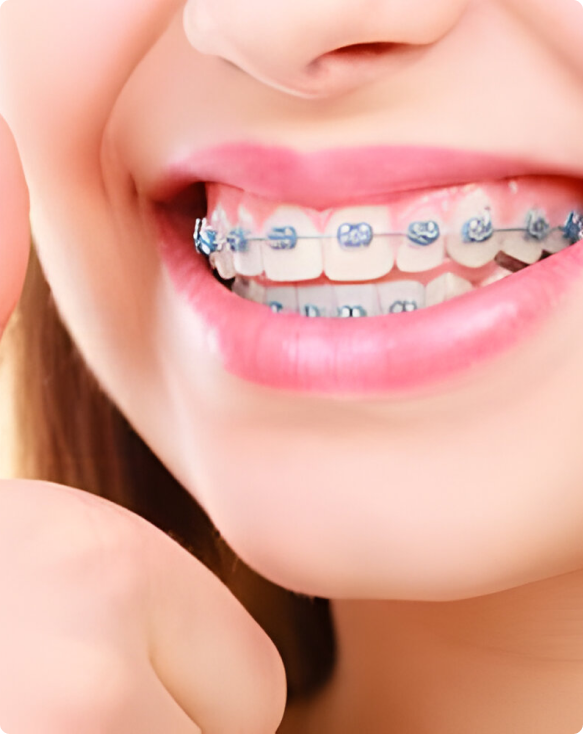 Image d'un adolescent portant des bagues orthodontiques pour corriger l'alignement des dents