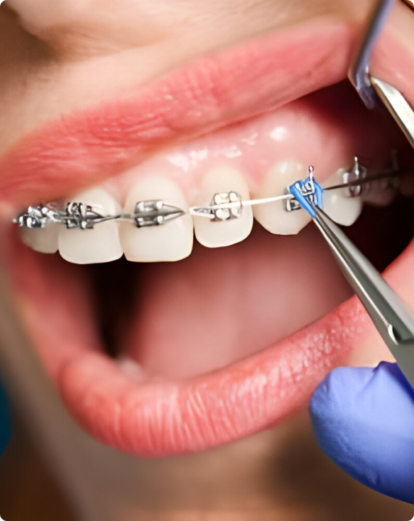 Photo après d'un patient ayant terminé un traitement orthodontique, montrant des dents redressées