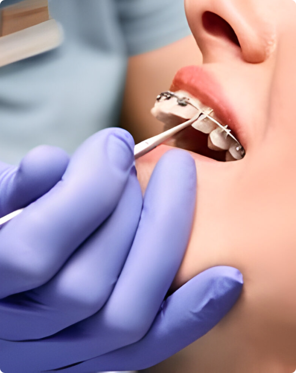 Image d'un dentiste ajustant un appareil orthodontique sur un patient