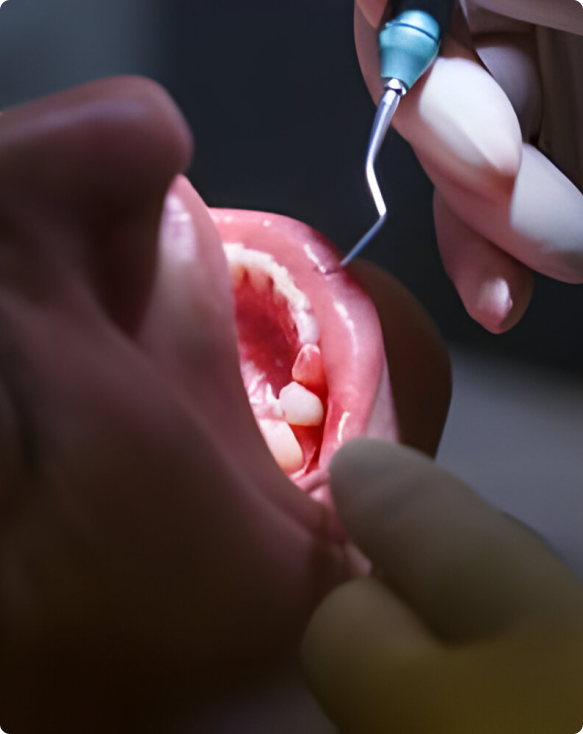 Photo de gencives saines et roses après un traitement parodontal