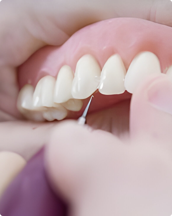 Image de prothèses dentaires complètes, montrant leur aspect naturel