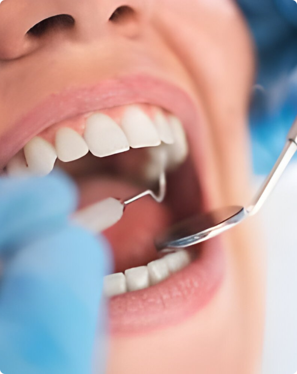 Gros plan sur une dent traitée avec un plombage